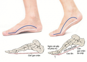 Một số mẫu giày dép dành cho nam và nữ có bàn chân bẹt