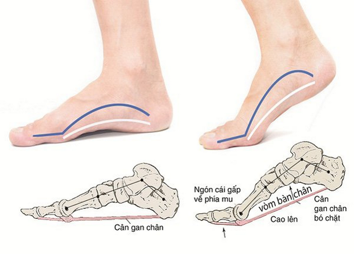 Một số mẫu giày dép dành cho nam và nữ có bàn chân bẹt